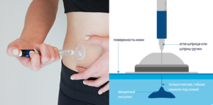 advance, i-port, i-portadvance, инъекционный, введение, инъекционныйпорт, инъекция